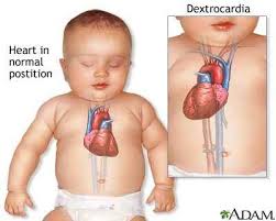 Cara Menyembuhkan Jantung Bocor Pada bayi